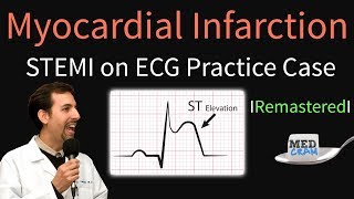 Myocardial Infarction  STEMI on ECG  Practice EKG [upl. by Elroy18]