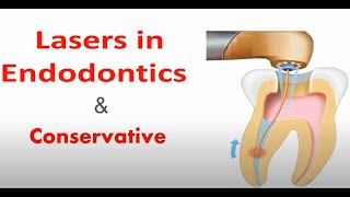 LASERS IN ENDODONTICS AND CONSERVATIVE DENTISTRY [upl. by Ehrman]