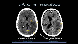 Intro to Head CT Part II Evaluation of Ischemic Stroke [upl. by Haleeuqa]