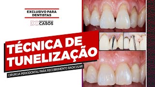 Técnica da Tunelização  Cirurgia Periodontal para Recobrimento Radicular [upl. by Spearman]