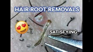 Squishys 3 Ingrown Hair Root Removals Microscopic [upl. by Ck500]