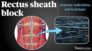 Rectus Sheath Block [upl. by Irod]