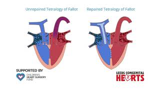 Tetralogy of Fallot [upl. by Klockau145]