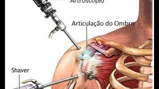 Cirugia no ombro explicações e informações [upl. by Hidie]