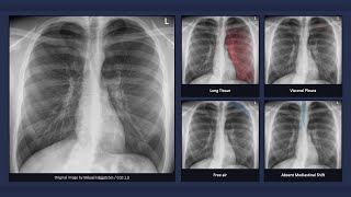 Simple Pneumothorax Explanation of Chest Xray Findings [upl. by Ahsinawt]