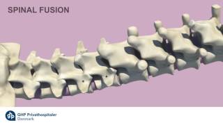 Oplever du rygsmeter Information om Stivgorende rygoperation  GHP Privathospitaler [upl. by Avner]