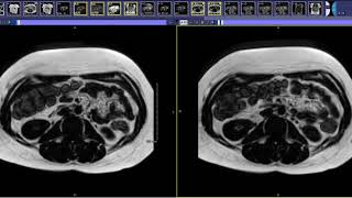 How to read a Liver MRI [upl. by Ahsirtal330]