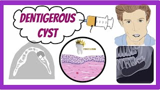 ORAL PATHOLOGY  DENTIGEROUS CYST [upl. by Adorl]