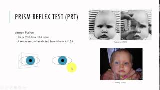 Prism Reflex Test [upl. by Rist775]