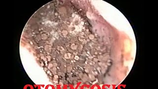 Severe fungal infection  Otomycosis ear cleaning [upl. by Nalad]