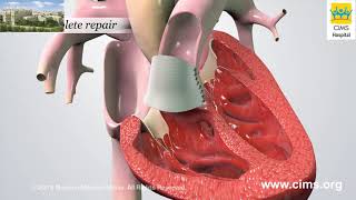 Tetralogy of Fallot by M Mazwi  OPENPediatrics [upl. by Naamann]