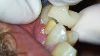 Dental Crown EXPLAINED and how much Tooth Youll Lose [upl. by Winola]