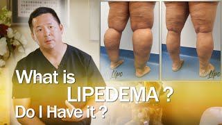 A Multipronged Approach to Lipedema Treatment with Dr Karen Herbst MD  Lipedema University [upl. by Aicina363]