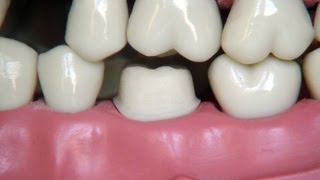 Full metal crown preparation  for dental students [upl. by Judas]