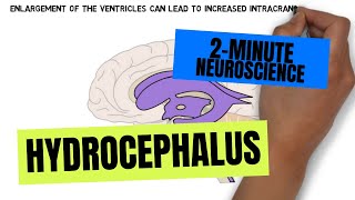 2Minute Neuroscience Hydrocephalus [upl. by Mac465]