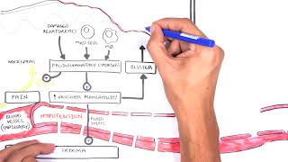 Burns  Pathophysiology [upl. by Ahsiuq]