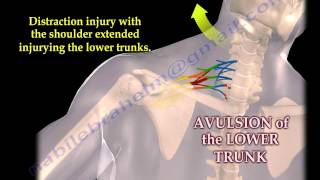 Brachial Plexus Mechanism Of Injury  Everything You Need To Know  Dr Nabil Ebraheim [upl. by Mandel]