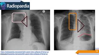 Imagenología de Tórax Signos Radiológicos [upl. by Sylas]