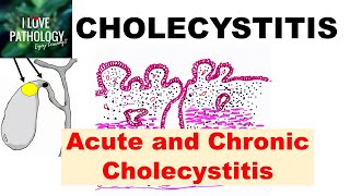 CHOLECYSTITIS Acute and Chronic Pathology and Complications [upl. by Osber]