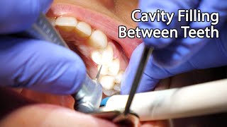 Dentist Filling A Cavity Between Teeth [upl. by Deborath602]