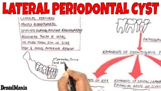 Lateral periodontal cyst  Pathogenesis Clinical Radiographic and Histopathologic features [upl. by Ybok]