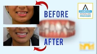 Invisalign Before and After Crowded Teeth [upl. by Akessej]