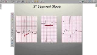 Effects of Ischemia on the ECG [upl. by Racso]