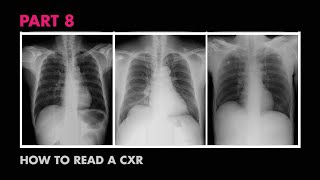 Diaphragms and Pleural Effusion  How to Read a Chest XRay Part 8  MEDZCOOL [upl. by Ittap]