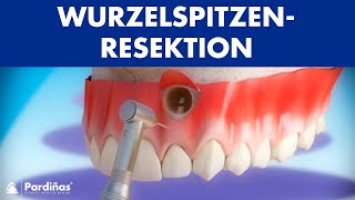 Wurzelspitzenresektion © [upl. by Eiveneg230]