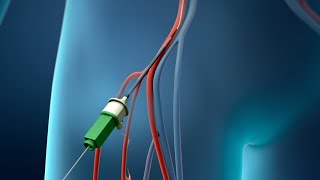 Coronary Angioplasty Femoral Access [upl. by Wade342]