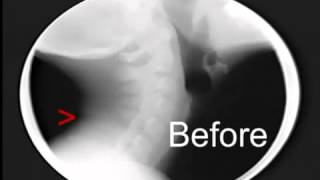 Neck Treatment under Motion X ray with the Arthrostim [upl. by Ronoc]