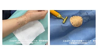 手首の粉瘤 ブログでも詳しく解説してます。 くりぬき法 東京皮膚のできものと粉瘤クリニック ふるばやし形成外科新宿院 大阪梅田形成外科クリニック [upl. by Namus]