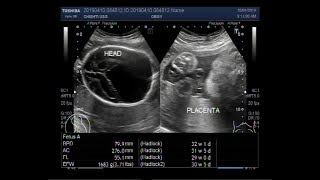 Ultrasound Video showing Fetal ventriculomegaly with bilateral renal parenchymal disease [upl. by Zeret]