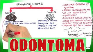 Odontoma  Types Clinical features Histopathological Features amp Treatment [upl. by Olodort340]