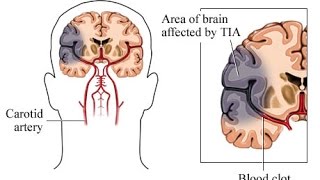 Transient Ischemic Attack TIA [upl. by Eibreh]