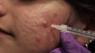 Watch amp Learn Intralesional injections [upl. by Hennahane227]