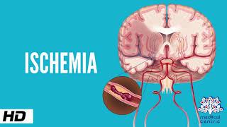 Ischemia Causes Signs and Symptoms Diagnosis and Treatment [upl. by Hendren]