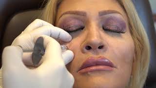 Allegra cole under eye injections for dark circles [upl. by Aneer]