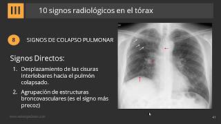 10 Signos Radiológicos en el Tórax [upl. by Inacana]