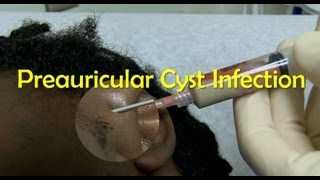 Preauricular Cyst Infection Management [upl. by Lurleen]