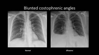 Pleural Effusions [upl. by Feune]