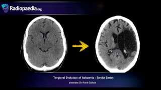 Stroke Evolution from acute to chronic infarction  radiology video tutorial CT MRI [upl. by Chill842]