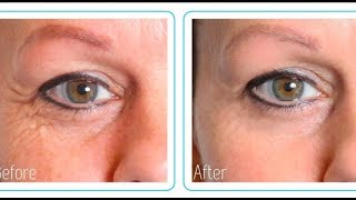 Hyaluronic Acid Before And After MY RESULTS [upl. by Victoria]