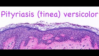 Pityriasis tinea versicolor [upl. by Reamy]