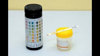 Dipstick Urinalysis Analysis [upl. by Riabuz]