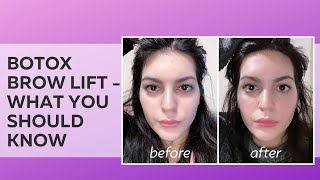 Getting Botox  Brow Lift  Before amp After VLOG [upl. by Murry]