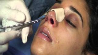 The Kotler Nasal Airway  Removal of the Airway [upl. by Fording]