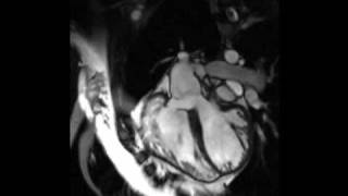 Cardiac MRI  Tetralogy of Fallot [upl. by Ydualc]