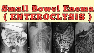 Small bowel enema  Enteroclysis [upl. by Eonak]