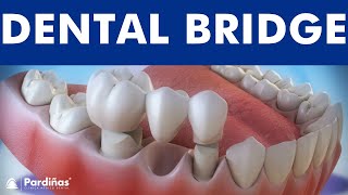 Dental bridge  Fixed dental replacement © [upl. by Colwen]